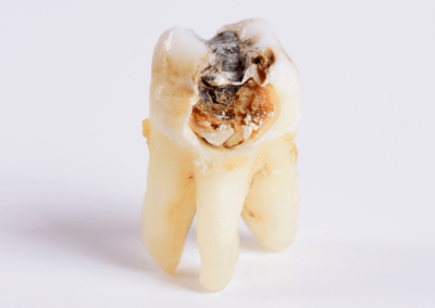 Zahn mit Resten von Amalgamfüllung